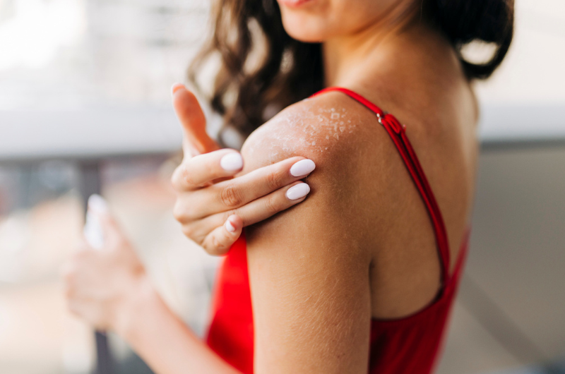 A brunette woman looks at her shoulder to see her sunburn.